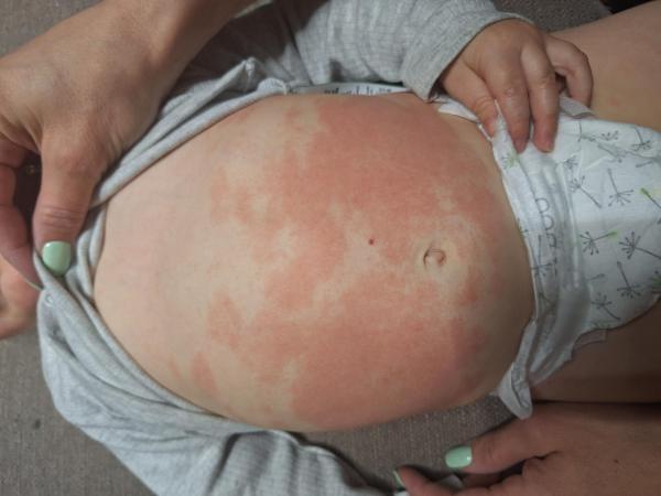 Bild zu Hautausschlag bei unserem Sohn (15 Monate) - Haut von Babys und Kindern ✔️ Expertenforum