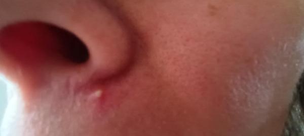 Bild zu Nachtrag Pickel - Haut von Babys und Kindern ✔️ Expertenforum