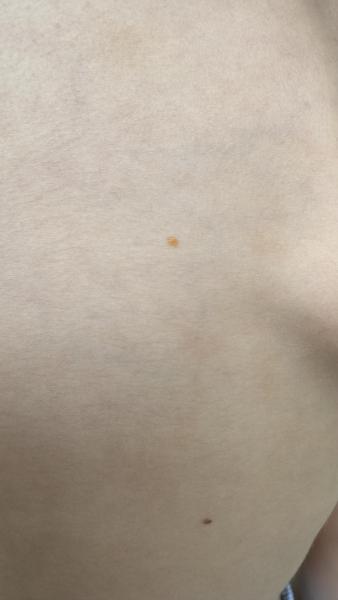 Bild zu Oranger Fleck auf der Haut - Haut von Babys und Kindern ✔️ Expertenforum