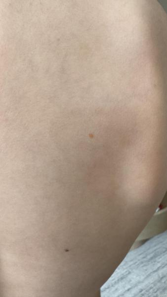 Bild zu Oranger Fleck auf der Haut - Haut von Babys und Kindern ✔️ Expertenforum