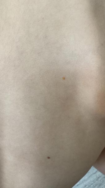 Bild zu Oranger Fleck auf der Haut - Haut von Babys und Kindern ✔️ Expertenforum