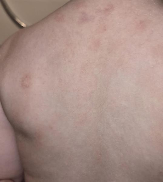 Bild zu kreisrunde trockene Stellen - Haut von Babys und Kindern ✔️ Expertenforum