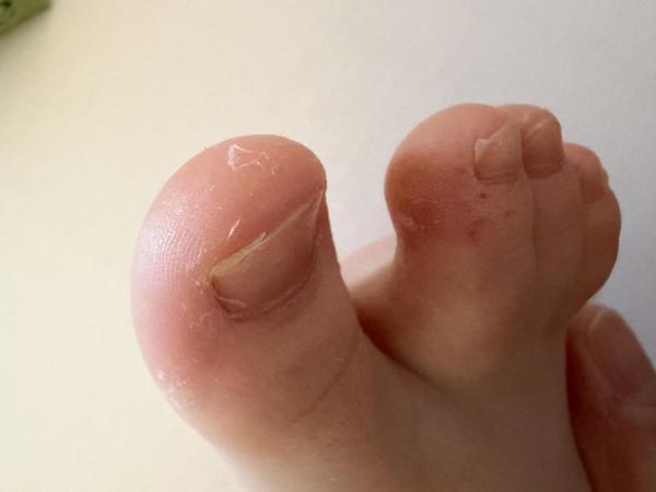 Bild zu Auschlag am Zeh - Haut von Babys und Kindern ✔️ Expertenforum