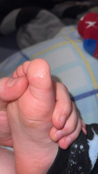 Bild zu Pilz ? - Haut von Babys und Kindern ✔️ Expertenforum