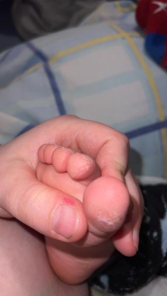 Bild zu Pilz ? - Haut von Babys und Kindern ✔️ Expertenforum