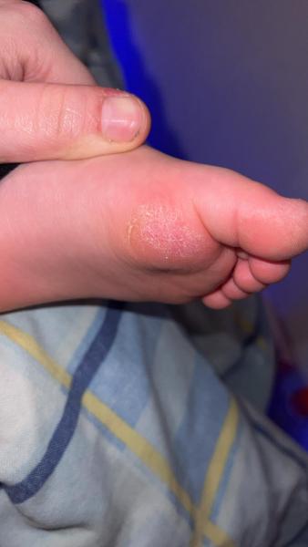 Bild zu Pilz ? - Haut von Babys und Kindern ✔️ Expertenforum