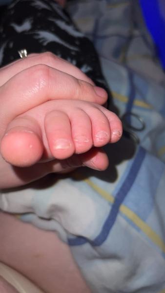 Bild zu Pilz ? - Haut von Babys und Kindern ✔️ Expertenforum