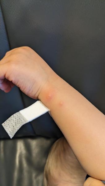 Bild zu Rote auffällige Erhebungen - Haut von Babys und Kindern ✔️ Expertenforum