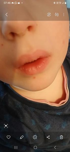 Bild zu Pickelchen - Haut von Babys und Kindern ✔️ Expertenforum