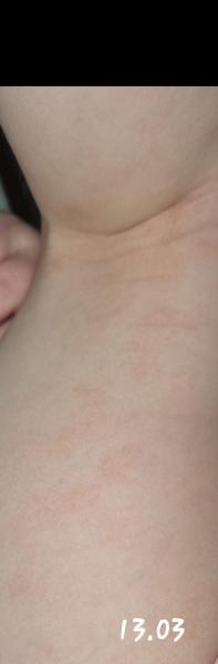 Bild zu Frage - Haut von Babys und Kindern ✔️ Expertenforum