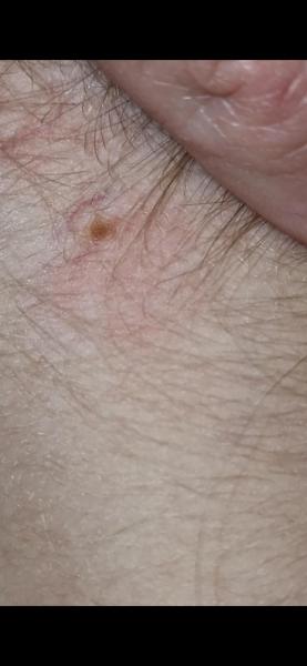 Bild zu Leberfleck - Haut von Babys und Kindern ✔️ Expertenforum