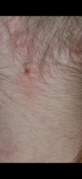 Bild zu Leberfleck - Haut von Babys und Kindern ✔️ Expertenforum