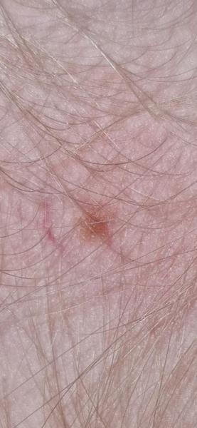 Bild zu Leberfleck - Haut von Babys und Kindern ✔️ Expertenforum