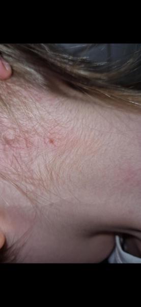 Bild zu Leberfleck - Haut von Babys und Kindern ✔️ Expertenforum