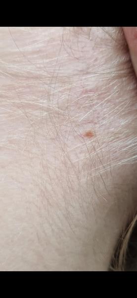 Bild zu Leberfleck - Haut von Babys und Kindern ✔️ Expertenforum