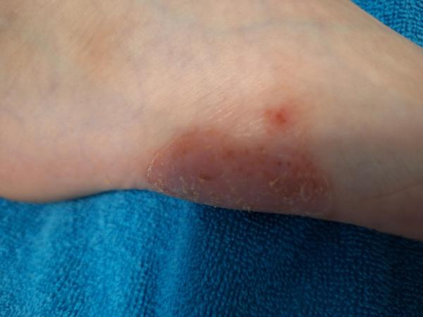 Bild zu Fussekzem- Neurodermitis? - Haut von Babys und Kindern ✔️ Expertenforum