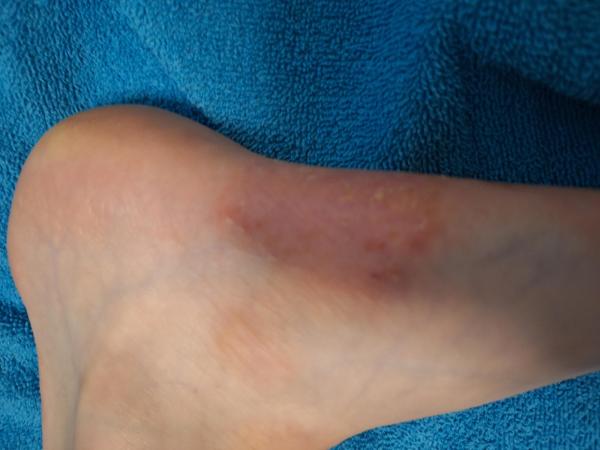 Bild zu Fussekzem- Neurodermitis? - Haut von Babys und Kindern ✔️ Expertenforum