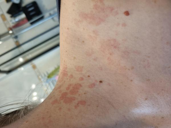 Bild zu Rote Flecken am Hals - Haut von Babys und Kindern ✔️ Expertenforum