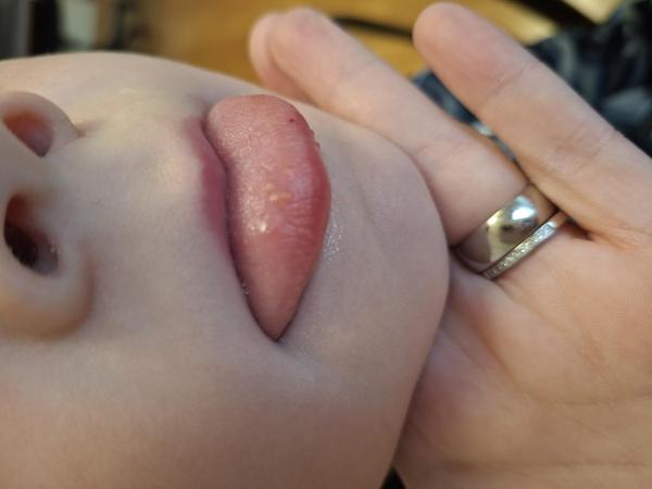 Bild zu Wiederkehrende Zungenentzündung - Haut von Babys und Kindern ✔️ Expertenforum