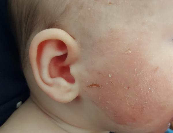 Bild zu Exzem / Pollenflug - Haut von Babys und Kindern ✔️ Expertenforum