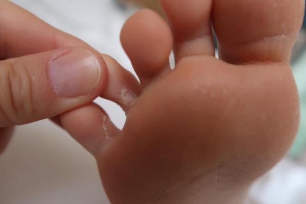 Bild zu Zustand Füße - trockene Haut oder ernster? - Haut von Babys und Kindern ✔️ Expertenforum