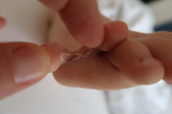 Bild zu Zustand Füße - trockene Haut oder ernster? - Haut von Babys und Kindern ✔️ Expertenforum