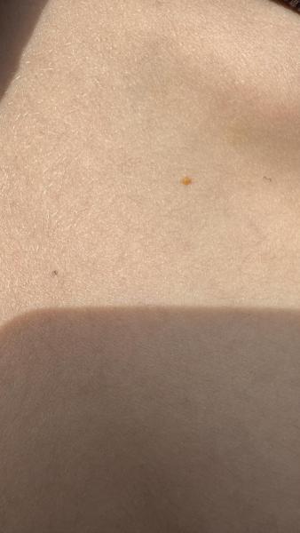 Bild zu Antwort: oranger Fleck - Haut von Babys und Kindern ✔️ Expertenforum