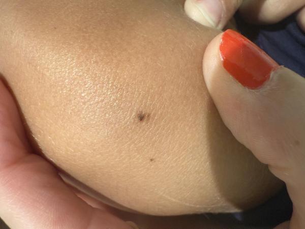 Bild zu Muttermal - Haut von Babys und Kindern ✔️ Expertenforum