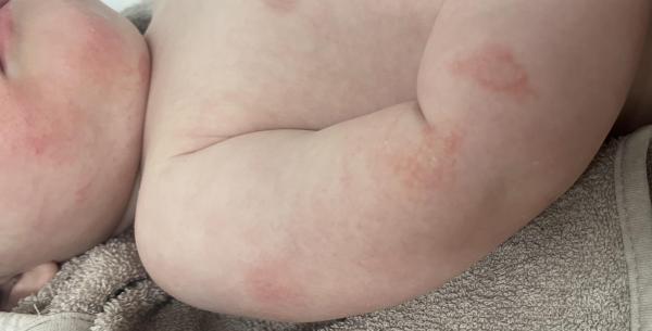 Bild zu Hefepilz zurück? - Haut von Babys und Kindern ✔️ Expertenforum