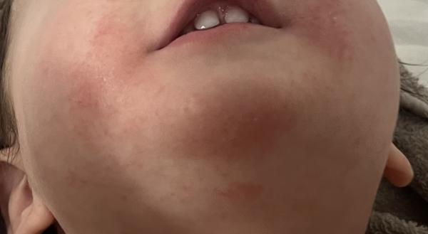 Bild zu Hefepilz zurück? - Haut von Babys und Kindern ✔️ Expertenforum