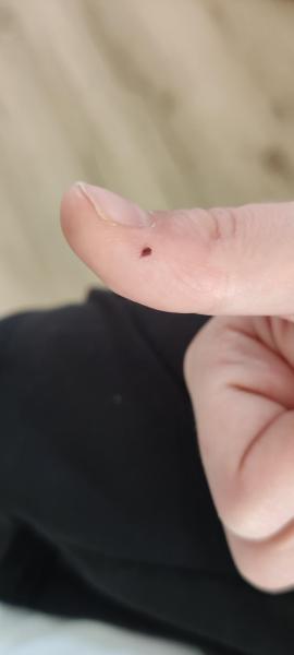 Bild zu Kleine dunkle Stelle am Daumen - Haut von Babys und Kindern ✔️ Expertenforum