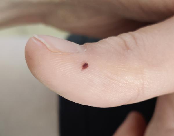 Bild zu Kleine dunkle Stelle am Daumen - Haut von Babys und Kindern ✔️ Expertenforum