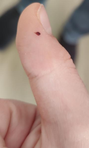 Bild zu Kleine dunkle Stelle am Daumen - Haut von Babys und Kindern ✔️ Expertenforum