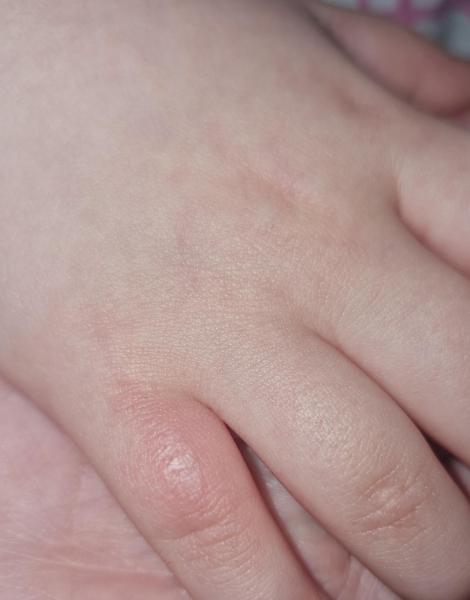 Bild zu Verbrennung - Haut von Babys und Kindern ✔️ Expertenforum