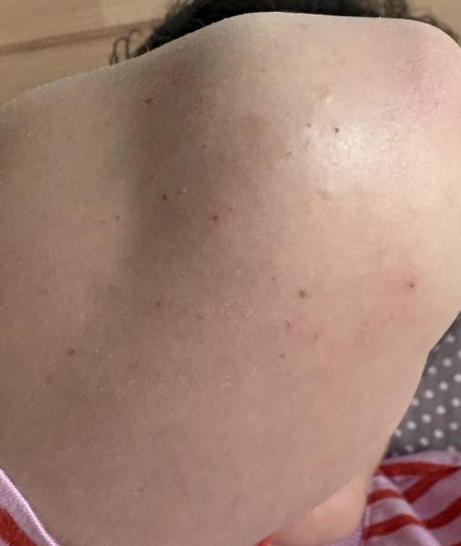 Bild zu Juckendes Ekzem am Ellbogen - Haut von Babys und Kindern ✔️ Expertenforum