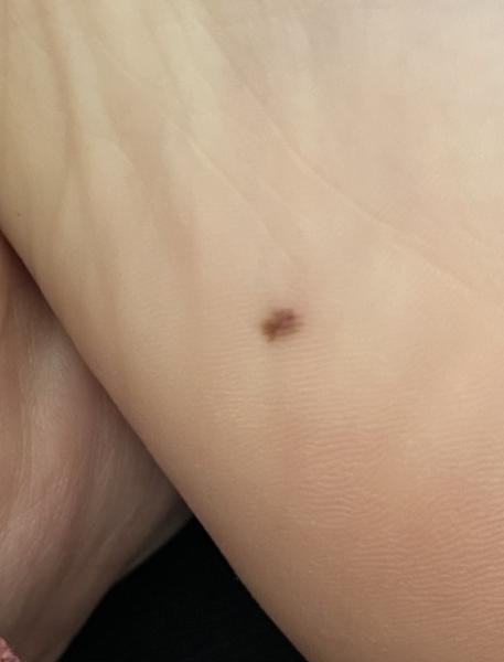 Bild zu Leberfleck unter dem Fuß - Haut von Babys und Kindern ✔️ Expertenforum