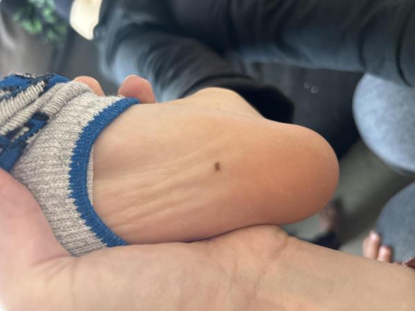 Bild zu Leberfleck unter dem Fuß - Haut von Babys und Kindern ✔️ Expertenforum