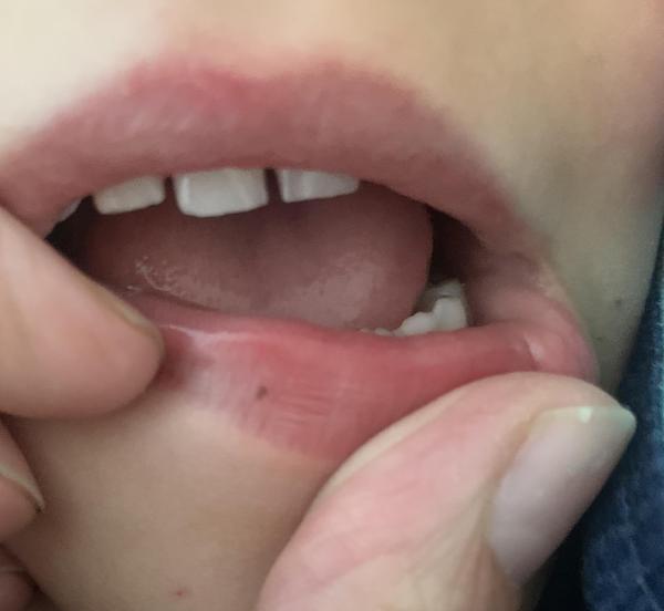 Bild zu Muttermal auf Unterlippe - Haut von Babys und Kindern ✔️ Expertenforum