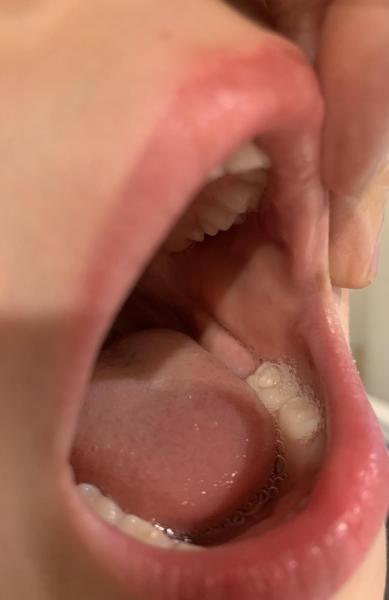 Bild zu Muttermal auf Unterlippe - Haut von Babys und Kindern ✔️ Expertenforum