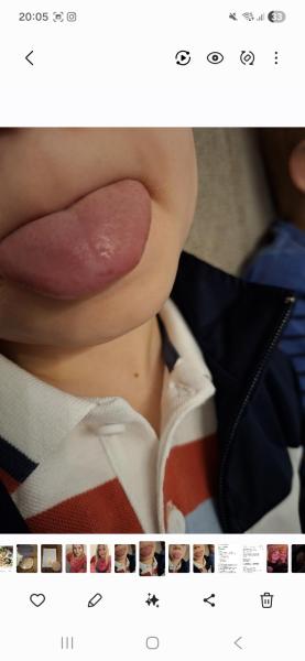 Bild zu Wiederkehrende Zungenentzündung - Haut von Babys und Kindern ✔️ Expertenforum