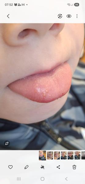 Bild zu Wiederkehrende Zungenentzündung - Haut von Babys und Kindern ✔️ Expertenforum