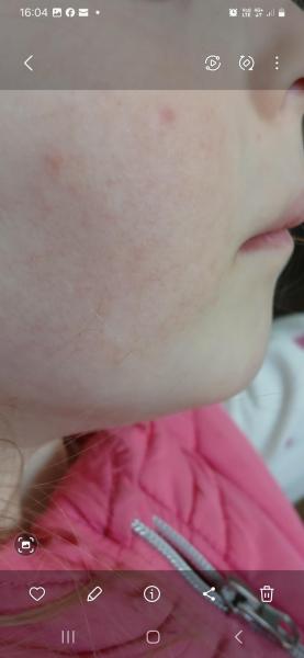 Bild zu Wangenekzem - Haut von Babys und Kindern ✔️ Expertenforum