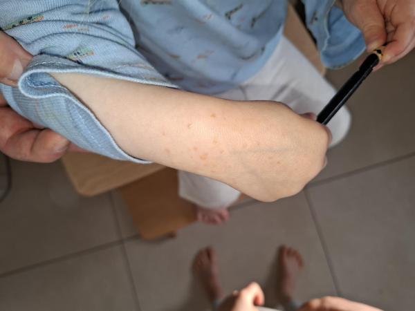 Bild zu Hautausschlag zweijähriges Kind - Haut von Babys und Kindern ✔️ Expertenforum