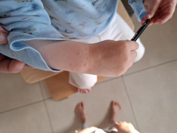 Bild zu Hautausschlag zweijähriges Kind - Haut von Babys und Kindern ✔️ Expertenforum