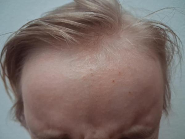 Bild zu Ausschlag auf der Stirn - Haut von Babys und Kindern ✔️ Expertenforum
