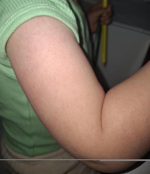 Bild zu Was ist das nur ? - Haut von Babys und Kindern ✔️ Expertenforum