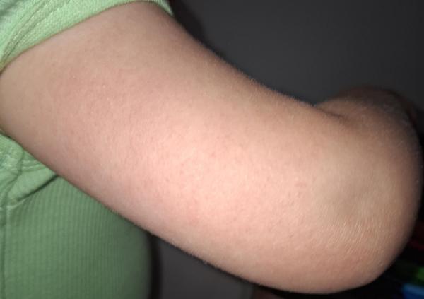 Bild zu Was ist das nur ? - Haut von Babys und Kindern ✔️ Expertenforum