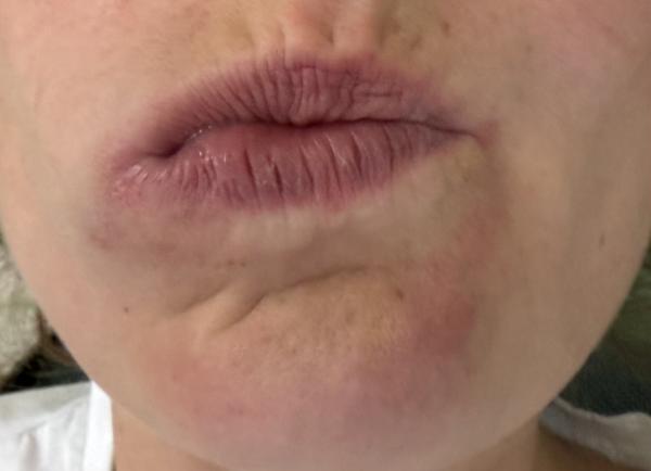 Bild zu Herpes - Haut von Babys und Kindern ✔️ Expertenforum