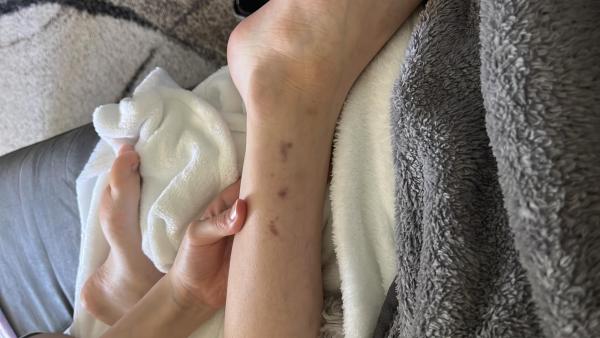 Bild zu Petechien - Haut von Babys und Kindern ✔️ Expertenforum