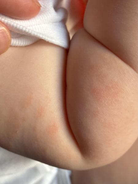 Bild zu Rote Flecken - Kind 11 Monate - Haut von Babys und Kindern ✔️ Expertenforum